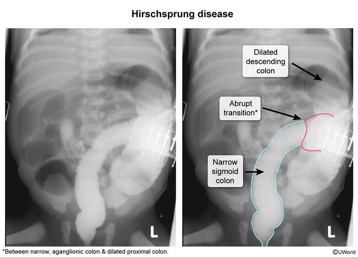 Hirschsprung – Bild 5