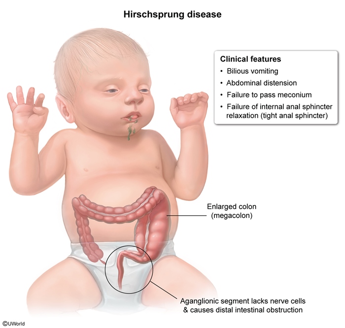 Hirschsprung – Bild 6